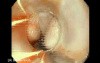 Upper GI Bleeding Due to Esophageal Varices - Banding of Varices, Part 1