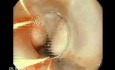 Upper GI Bleeding Due to Esophageal Varices - Banding of Varices, Part 1