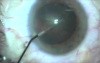 Fugo Plasma Ablation Surgery - new oportunities