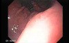 Presence of Multiple Irregular and Large Ulcers - Quick Look at the Lesions