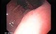 Presence of Multiple Irregular and Large Ulcers - Quick Look at the Lesions