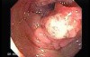 Adenocarcinoma of the Transverse Colon (1 of 5)