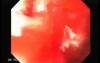 Synchronous Cancer Gastric and Esophageal(9 of 9 )
