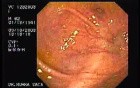 A Tablet of Medicine in the Colon (2 of 2)