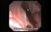 Adenocarcinoma of the Gastroesophageal Junction - Esophagus-Hernia Fistula, Part 1