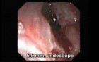 Adenocarcinoma of the Gastroesophageal Junction - Esophagus-Hernia Fistula, Part 1