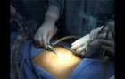 Total Extra Peritoneal (TEP) in 10 steps - Part 2