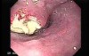 Small cell carcinoma of the lung that invades the upper and the middle third of the Esophagus (3 of 7)