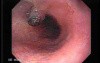 Long Standing Alcohol Abuse - Banded Varices At the Middle Third of Esophagus