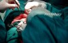 Excision of Leiomyomas