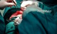 Excision of Leiomyomas