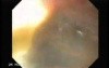 Synchronous Cancer Gastric and Esophageal (1 of 9 )