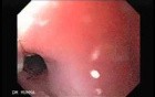 Esophageal Stricture After Total Gastrectomy And Chemoradiation - Application Of Mitomycin C - 1/2