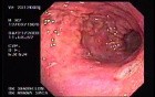 Acute Bleeding - Presence of Multiple Ulcers and Erosions