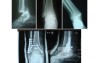 Trimalliolar fracture of Ankle