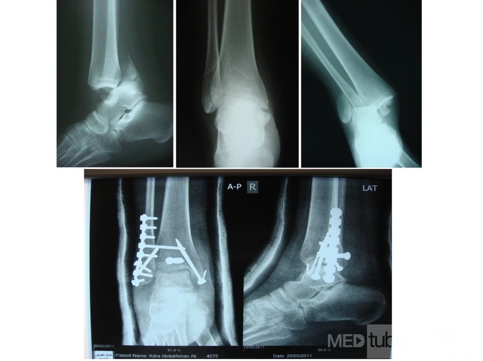 Trimalliolar fracture of Ankle