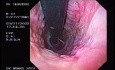 Banding of esophageal varices (2 of 17)
