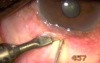 Sturge Weber Syndrome - Transconjunctival Transciliary Filtration