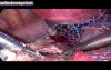 Treatment For Uterine Prolapse - Sacrocervicopexy