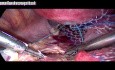 Treatment For Uterine Prolapse - Sacrocervicopexy