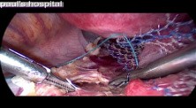 Treatment For Uterine Prolapse - Sacrocervicopexy