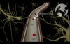 Atherosclerosis