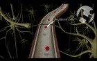 Atherosclerosis