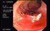Tubulo - Villous Adenoma - Endoscopy (17 of 28)