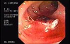 Tubulo - Villous Adenoma - Endoscopy (17 of 28)