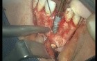 Reconstruction Of Bone - Intra-Bone Implant