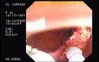 Tubulo - Villous Adenoma - Endoscopy (18 of 28)