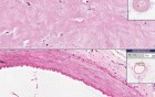 Coronary Artery - Atherosclerosis - Recanalization
