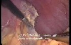 Left Adrenalectomy - Laparoscopic Approach