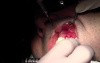 Threading - Gingival Grafting #11-12