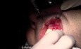 Threading - Gingival Grafting #11-12