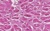 Amyloidosis - Heart - Histopathology