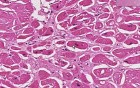 Amyloidosis - Heart - Histopathology