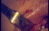 Regeneration Of Multialveolar Process (Left-Side) (3/3)
