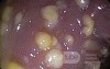 Endoscopic appearance of the Pseudomembranous colitis
