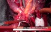 Amplatzer Device Embolization Of The Pulmonary Artery