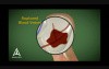 Stroke - 3D Medical Animation