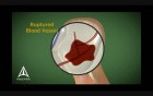 Stroke - 3D Medical Animation