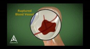Stroke - 3D Medical Animation
