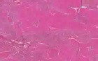 Spleen - Amyloidosis