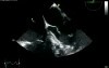 Severe Aortic Valve Regurgitation