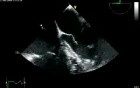 Severe Aortic Valve Regurgitation