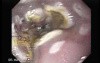 Endoscopic Ablation Of Barrett's Esophagus - 6/6