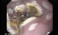 Endoscopic Ablation Of Barrett's Esophagus - 6/6