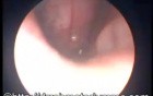 Nasopharyngeal Lymphoid Tissue Infection