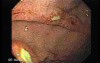 Duodenal Ulcers (3 of 4)
